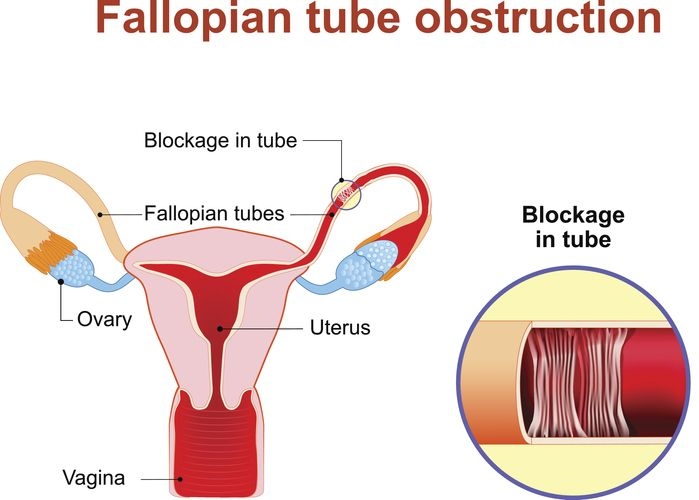 blocked fallopian tube image